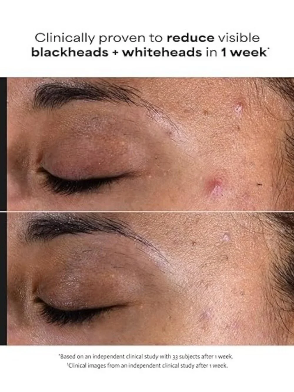 Paula's Choice SKIN PERFECTING 2% BHA Liquid Exfoliant & Pads Unisex